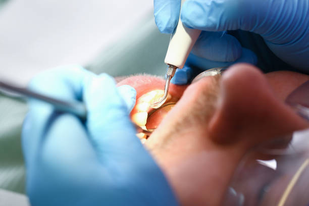 Best Emergency Tooth Extraction in Cool Valley, MO